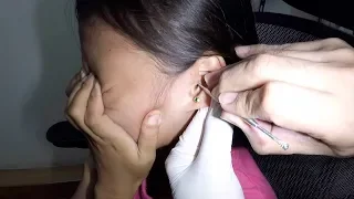 Something is Stuck in Girl's Ear for Years. Is it a Pellet or Earwax?