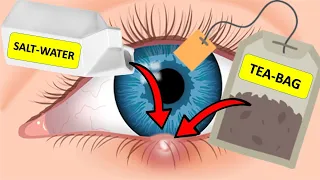 How To Get Rid of a Stye Overnight (USING SALT-WATER & TEABAGS)