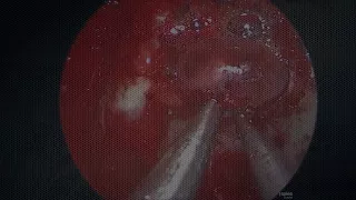 Endoscopic endonasal pituitary gland hemi-transposition for resection of a dorsum sellae meningioma