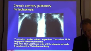 Diagnosis and treatment of chronic pulmonary aspergillosis