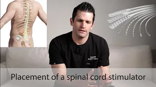 Spinal Cord Stimulator Placement