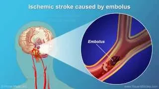 Understanding Stroke