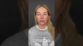 Как фейслифтинг и платизмопластика меняет людей😍 Доктор БЛОХИН С.Н.