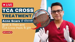 TCA Cross Treatment Live | Remove Acne Scars with TCA Cross Peels  | Dr Jangid | SkinQure