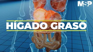 Hígado graso - #ExclusivoMSP