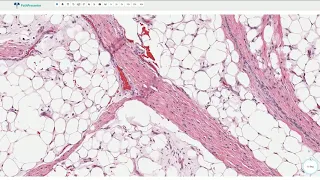 Lipoblastoma - Histopathology