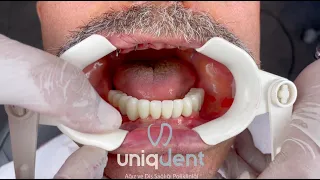 12 İmplant Üzerine Yapılan 24 Zirkonyum Kuron Diş Tedavisi Uyguladığımız Hastamız.