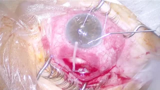 Paracentesis- Tube 1