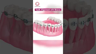 Teeth Alignment with Braces (3D Animation) #shorts