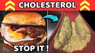 Stop Now! 10 Foods Dangerous For Cholesterol And Heart Health.