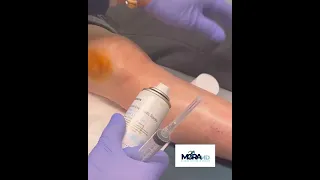 Knee Water Removal - Another Painless Technique