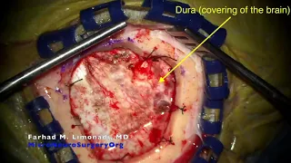 Brain tumor resection surgery