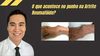 What happens in the wrist in Rheumatoid Arthritis?
