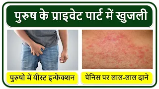 पुरुष के प्राइवेट पार्ट में खुजली, पेनिस पर लाल-लाल दाने, Penis yeast infection, Balanitis Treatment