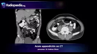 Acute appendicitis on CT - radiology video tutorial