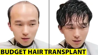 Is Perfect Hair in Asia a Scam? Surgeon Reacts