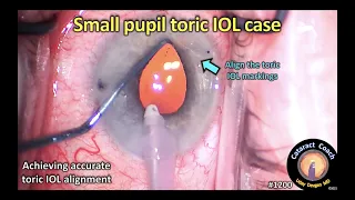 CataractCoach 1200: toric IOL with a small pupil - how do you do it?