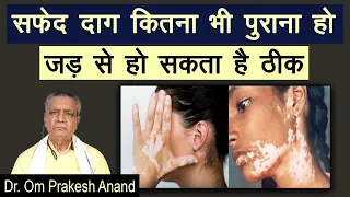 सफेद दाग कितना भी पुराना हो जड़ से हो सकता है ठीक || Dr. Om prakesh anand