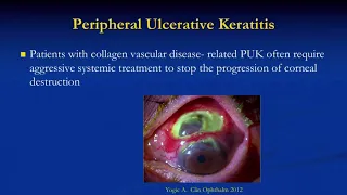 COR07 03   Section VI Inflammatory Diseases of the Cornea   Is This Infection or Peripheral Ulcerati