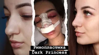 РИНОПЛАСТИКА DARK PRINCESS | одна в Ереване | ДО и ПОСЛЕ