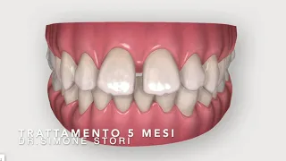 Invisalign Prima e Dopo [DIASTEMI - SPAZI TRA I DENTI] - Bologna