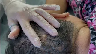 Удаление родинки на волосистой части головы иссечение+электрокоагуляция