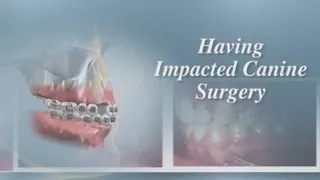 Having Impacted Canine Surgery