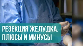 Продольная резекция желудка. Плюсы и минусы