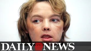 Woman Who Received World's 1st Face Transplant Dies