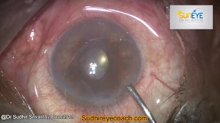 Reason For Persisting Corneal Edema After Cataract Surgery (Voice-Over)-DR SUDHIR SRIVASTAVA