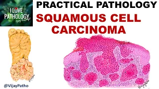 SQUAMOUS CELL CARCINOMA: Clinical features & Morphology; Premalignant lesions