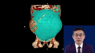 3D Imaging in Cancer Surgery - Brigham and Women's Hospital