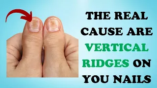 6 Causes Of Vertical Lines On Your Nails | Healthy Care