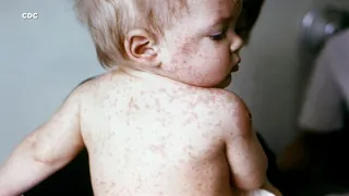 Your child has a viral rash, but which one is it? Here’s a comparison.