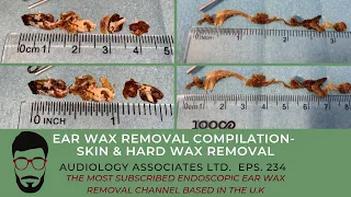 EAR WAX REMOVAL COMPILATION - SKIN & HARD EAR WAX REMOVAL - EP 234