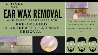 PRE-TREATED AND UNTREATED EARWAX REMOVAL - EP388