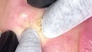 Blackheads on chin!