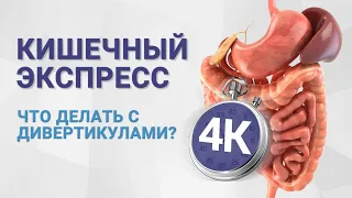 №4к КИШЕЧНЫЙ ЭКСПРЕСС. Что делать с дивертикулами?