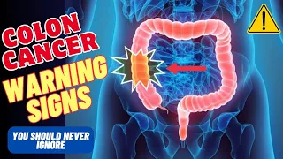 7 Warning Signs Of Colon Cancer In Men You Should Never Ignore