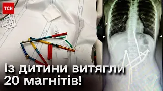 😱🧲 Проковтнув аж 20 магнітів! Лікарі врятувати хлопчика і нагадали батькам про небезпеку "іграшки"