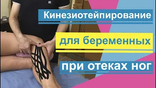 Помощь при отеках ног. Кинезиотейпирование ног для беременных. Help with swelling of the legs.