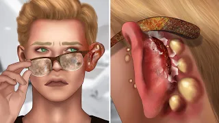 ASMR Popping pustules behind the pinna due to dirty glasses | Earwax animation