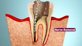 Root Canal Treatment in 40 Seconds