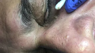 Old Eye Blackheads Part 2 by Dr.Lalit Kasana