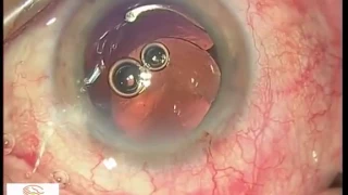 Femtosecond Laser Cataract Surgery Step by Step - Oftalvist