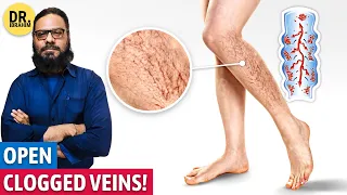 Band Naso Ko Khole Ka Qudrati Ilaj | Naturally Treat Varicose Veins | Dr. Ibrahim