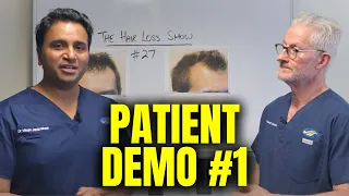Patient Demonstration of Male Pattern Hair Loss