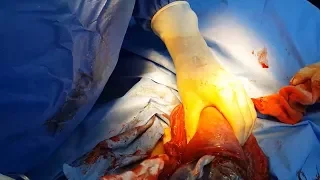 Step-by-step caesarean section - step 4 - placental delivery