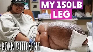 The Woman With The 150lb Leg | BORN DIFFERENT