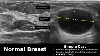 Small Parts Ultrasound Normal Vs Abnormal Images | Thyroid, Breast, Scrotum, Testis, Eye USG